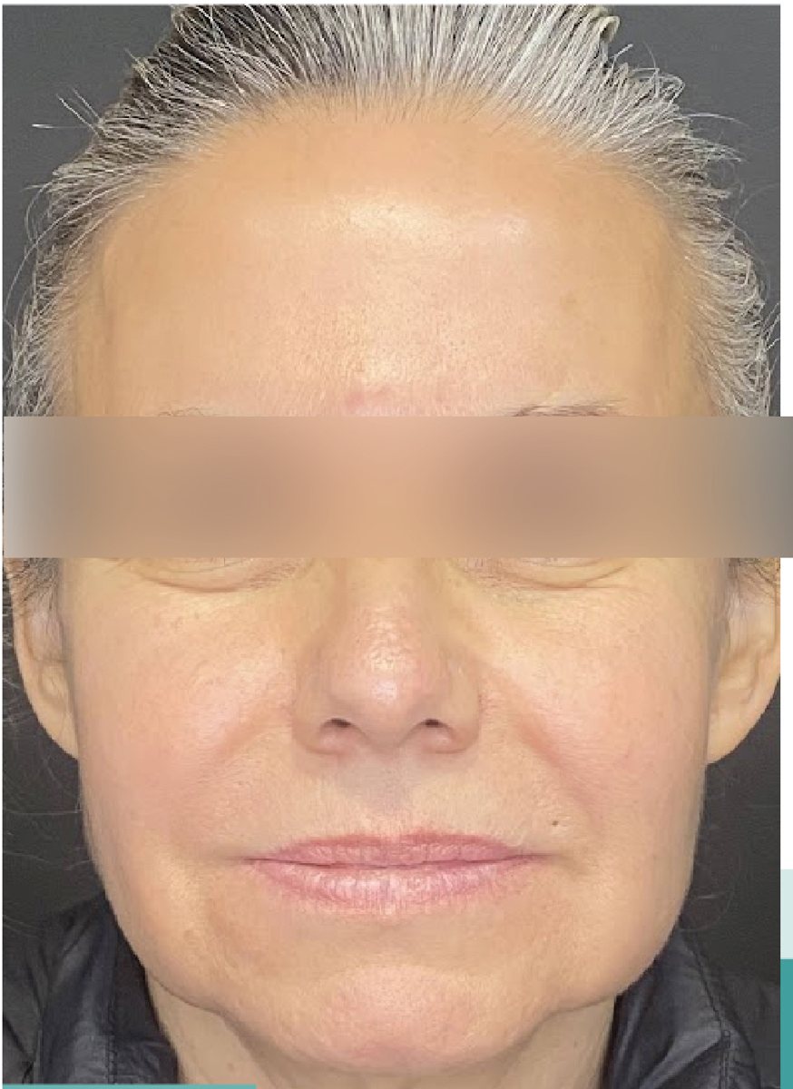 Lifting facial: antes
