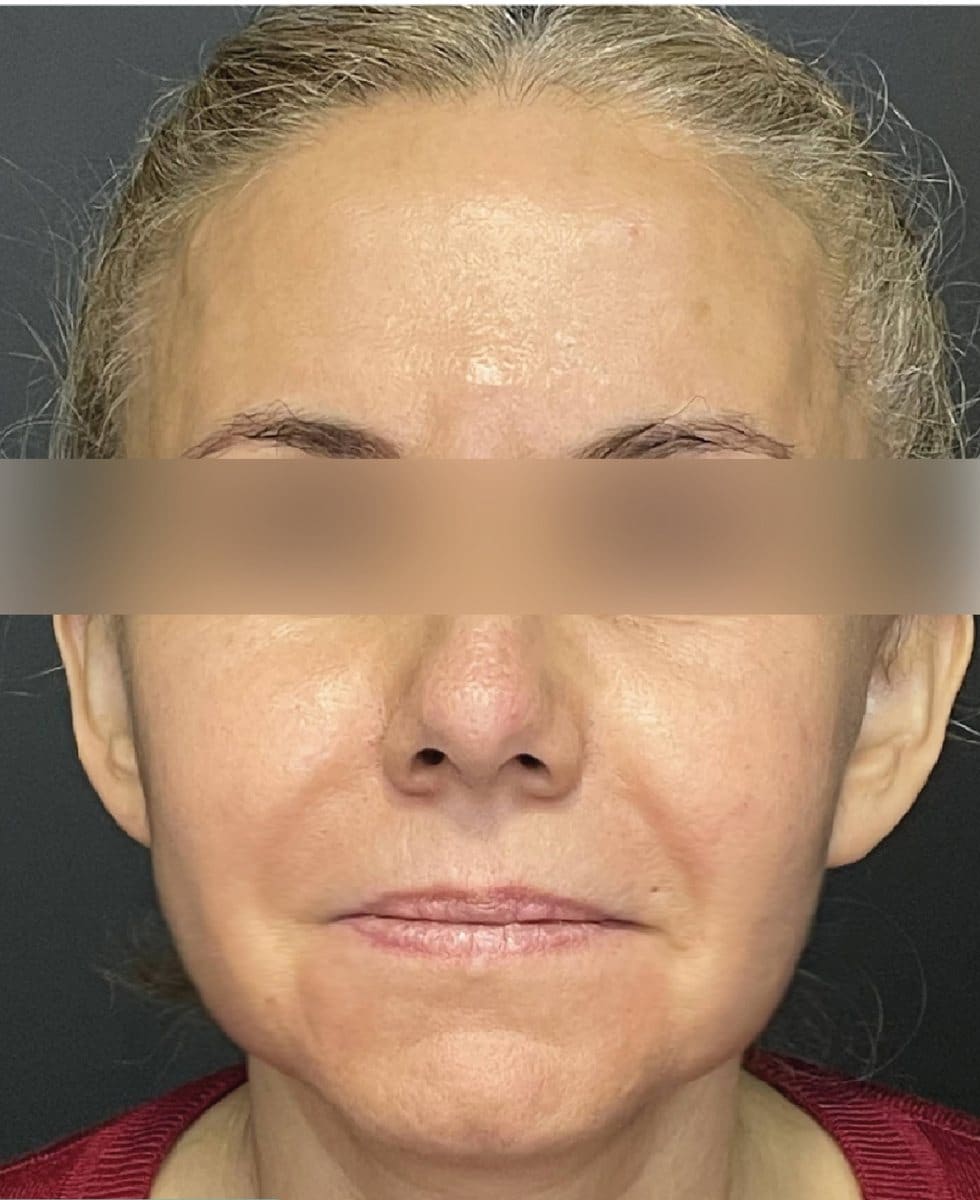 Lifting facial: después