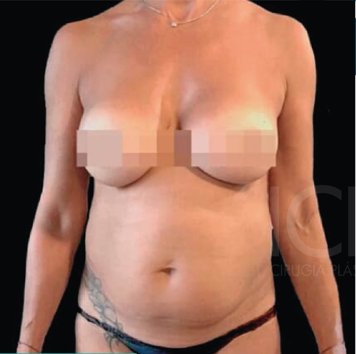 Mommy makeover: antes