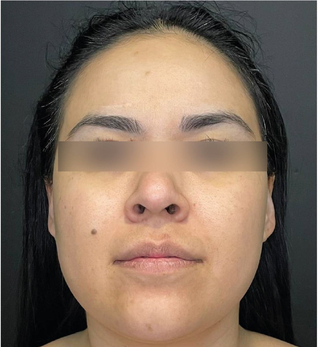 Lipopapada y bolsas de Bichat: antes