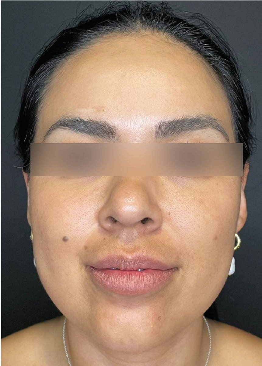 Lipopapada y bolsas de Bichat: después