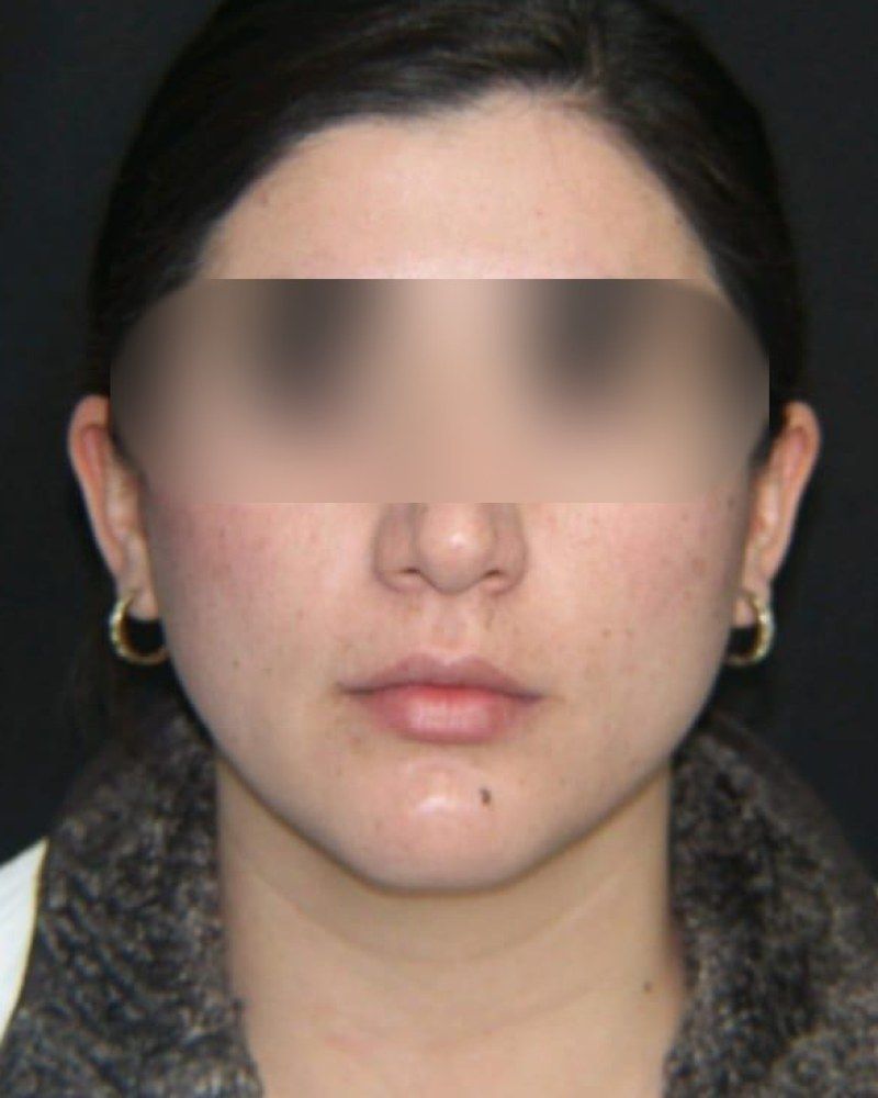 Rinoplastia: antes