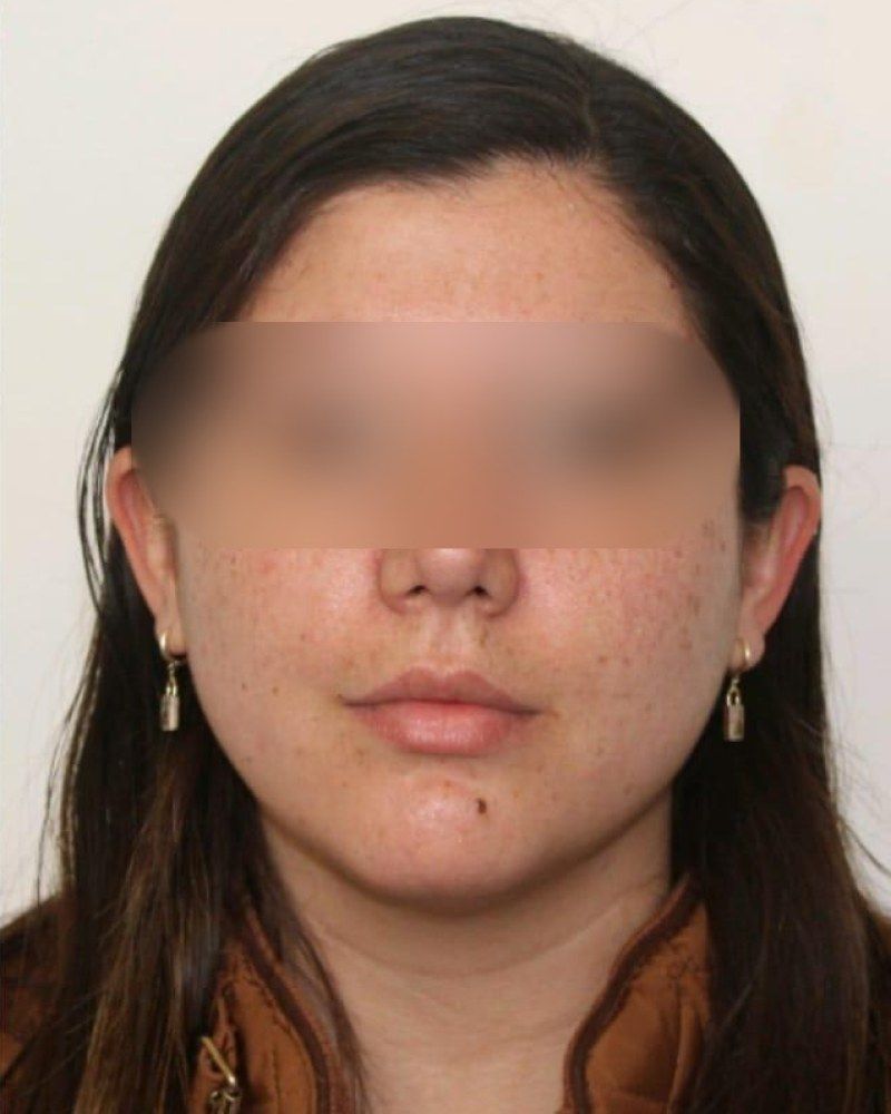 Rinoplastia: después
